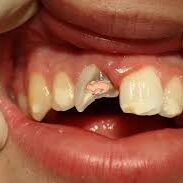 chipped tooth