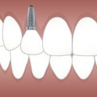 dental-implants