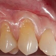 gum disease