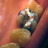 tooth filling